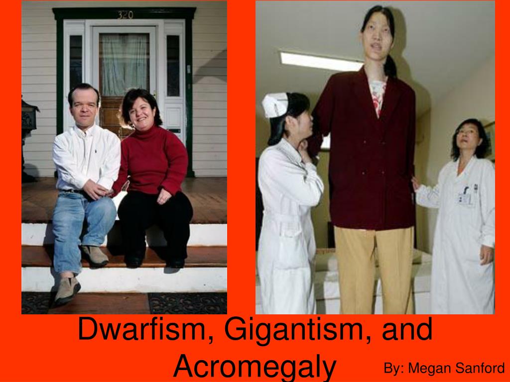 Гигантизм. Dwarfism and gigantism. Pituitary Dwarfism. Гигантизм медицинское название.