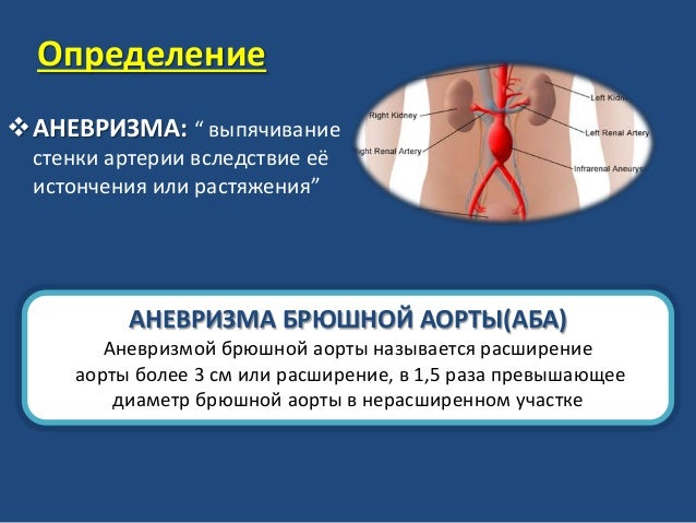 Аневризма брюшной аорты карта вызова