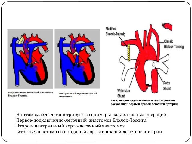 Частичный аномальный дренаж легочных вен. Перимембранозный дефект межжелудочковой перегородки. Тетрада Фалло. Для легочных вен характерно. Тетрада Фалло гемодинамика схема.