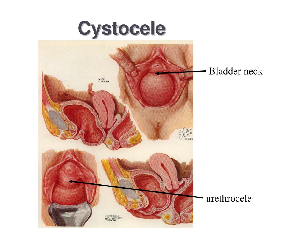 Цистоцеле это