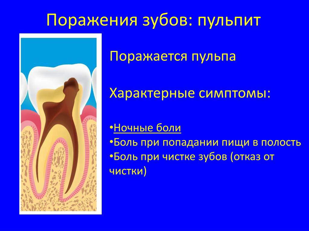 Пульпа зуба. Пульпит периодонтит зубов классификация. Основные симптомы пульпита. Пульпит симптомы жалобы.