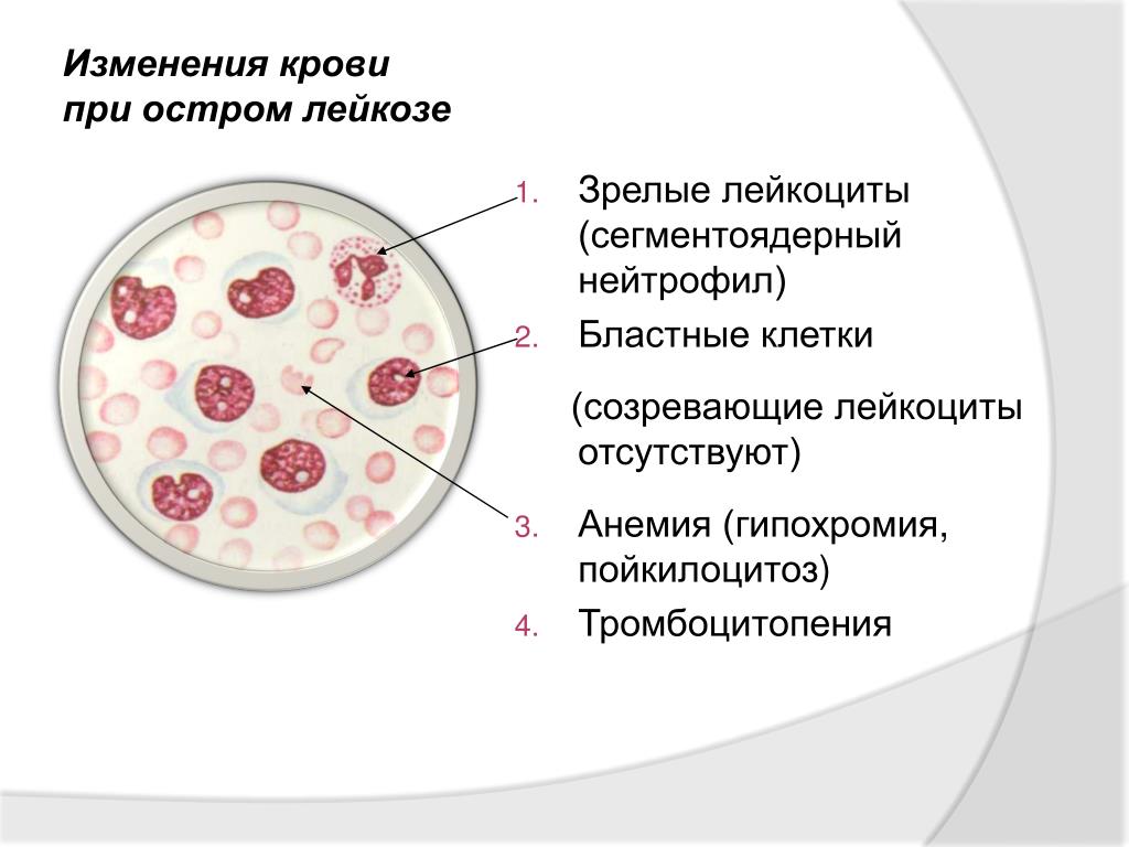 Изменения лейкоцитов в крови. Изменения крови при остром лейкозе. Патогенез острого лейкоза. Изменения лейкоцитов.