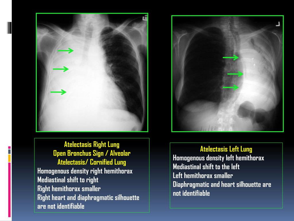 Ателектазы рентген схема