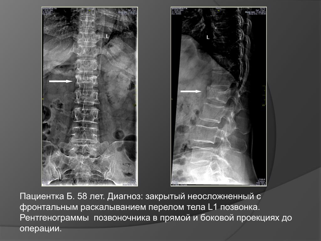 Рентген отдела позвоночника. Компрессионный перелом l1 позвонка рентген. Компрессионный перелом позвоночника рентгенограмма. Компрессионный перелом грудного отдела позвоночника рентген. Перелом грудного позвонка рентген.