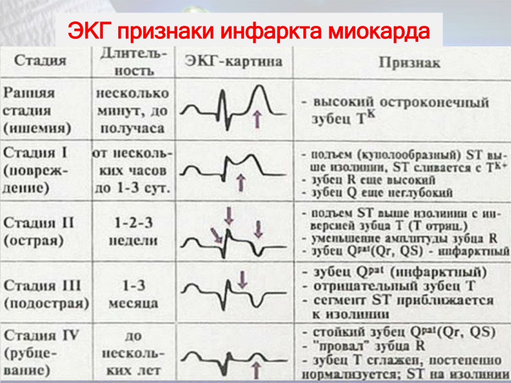 Стенокардия напряжения карта смп