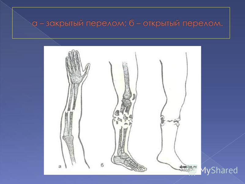 Рисунок перелома кости