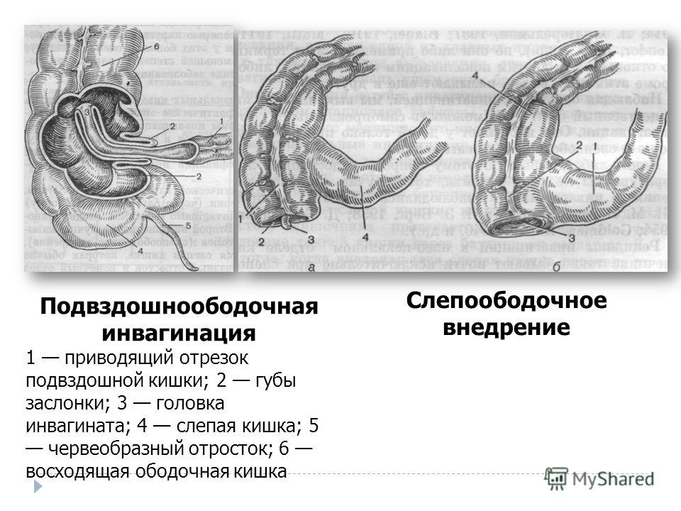 Слепая кишка стенки. Илеоцекальная кишечная инвагинация. Заворот кишок (инвагинация). Слепо ободочная инвагинация.