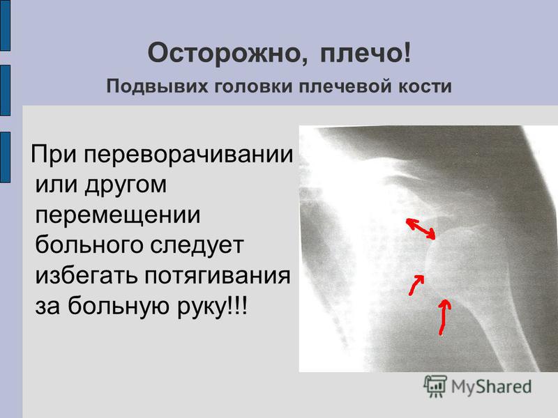 Подвывих. Подвывих плечевого сустава. Подвывих плечевой кости. Нижний подвывих плечевой кости. Подвывих головки плечевой кости.