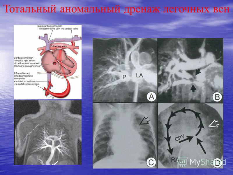 Аномальный дренаж легочных вен. Супракардиальная форма тотального аномального дренажа легочных вен. Аномальный дренаж легочных вен рентген. Частичный аномальный дренаж легочных вен. Тотальный аномальный дренаж легочных вен.