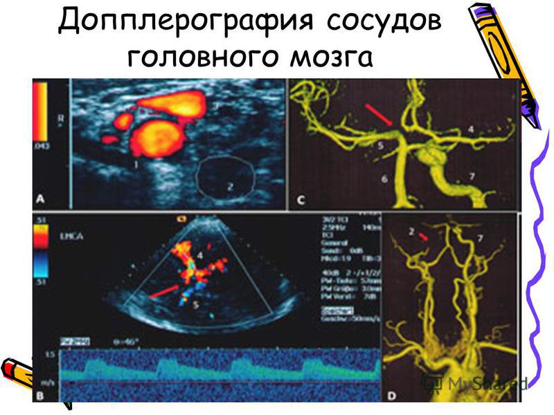 Что такое уздг. Допплерография периферических сосудов. Допплерография сосудов головного мозга. Транскраниальная допплерография сосудов головного мозга и шеи. УЗДГ транскраниальных сосудов.