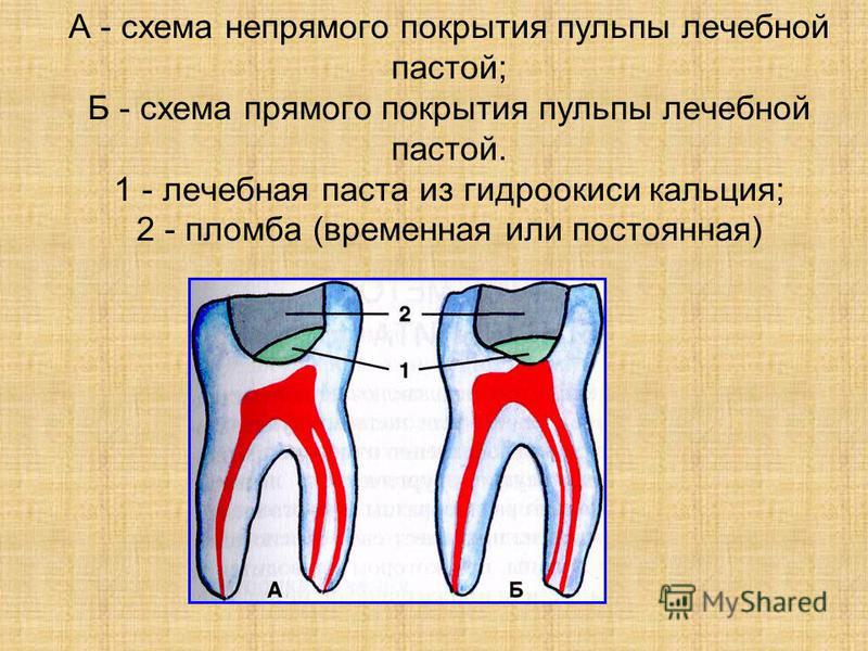 Схема лечения пульпита