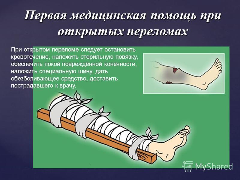 Первая при закрытом переломе. Первая помощь при переломах. ПМП при закрытых переломах. Оказание первой медицинской помощи при переломах. Оказание первой медпомощи при переломах.