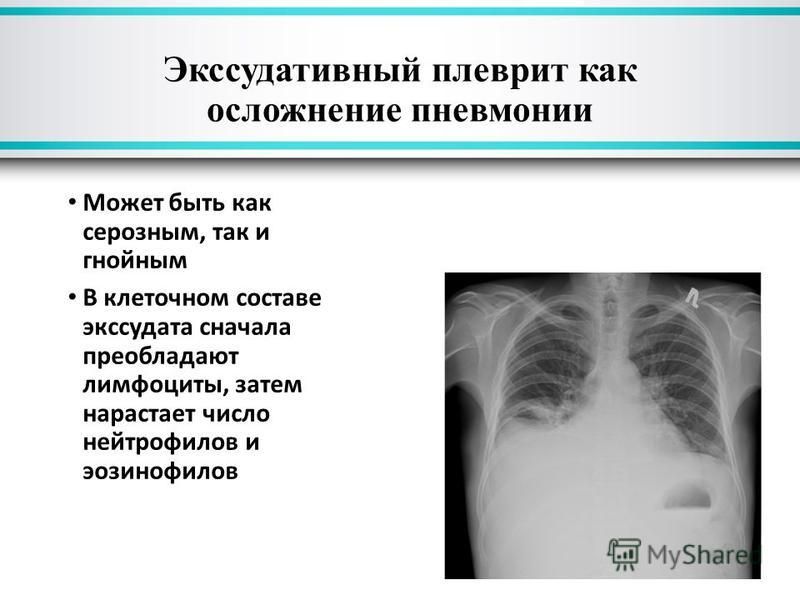 Плеврит клинические рекомендации