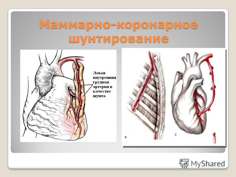 После операции коронарного шунтирования. Операция шунтирование сосудов сердца. Схема операции аортокоронарного шунтирования. Аортокоронарное шунтирование этапы операции. Шунтирование коронарных артерий сердца.