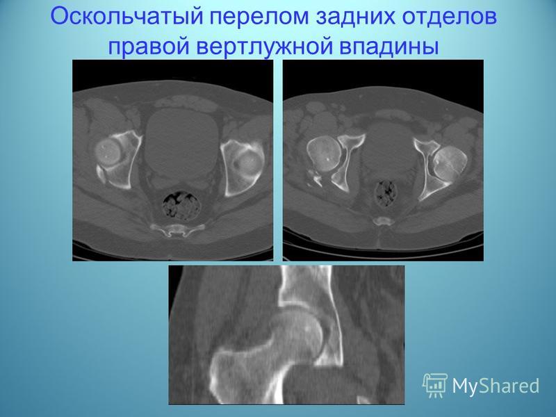 Перелом задней стенки вертлужной впадины со смещением