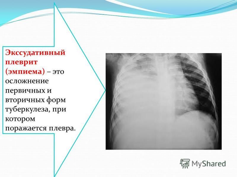 Плеврит что это. Экссудативный плеврит туберкулез. Двусторонний экссудативный плеврит рентген. Осложнения туберкулезной эмпиемы плевры. Костодиафрагмальный плеврит.