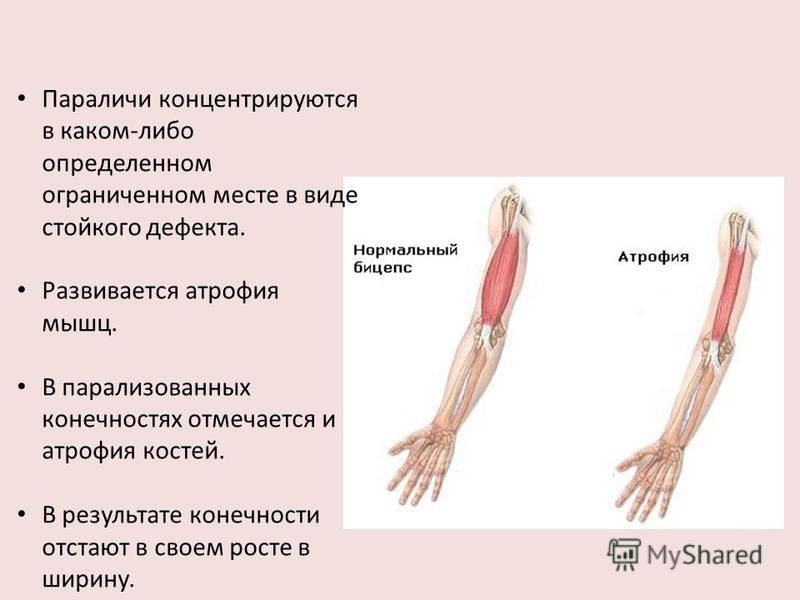 Мышечная атрофия