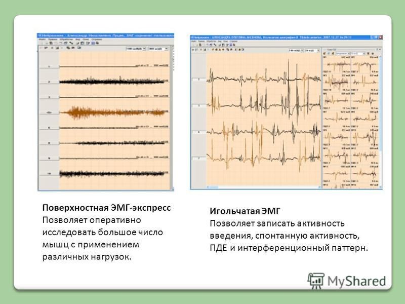 Эмг самара. ЭМГ электроды. Расшифровка ЭМГ исследования. Поверхностная ЭМГ методика проведения. ЭНМГ схемы.