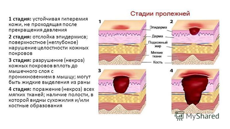 Стадия пролежней клиническая картина сестринские вмешательства