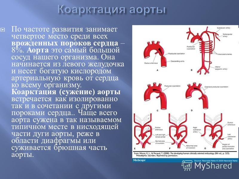 Что означает уплотнения аорты