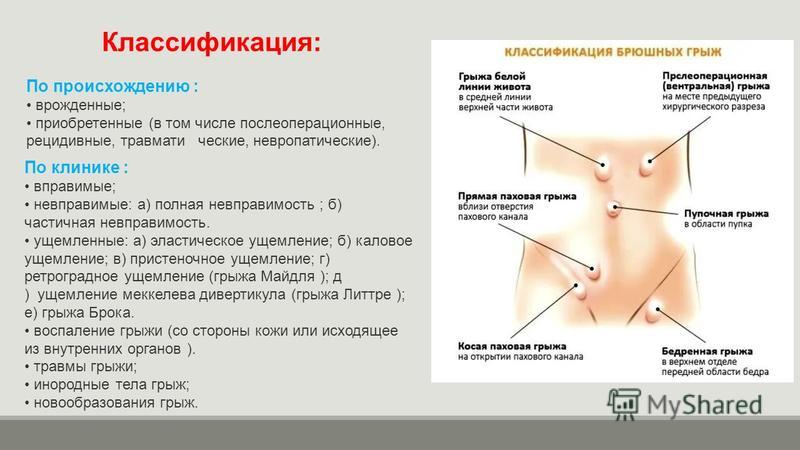 Грыжа белой линии живота на узи фото описание у женщин