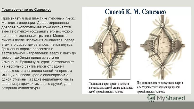 Пластика пупочной грыжи. Грыжесечение с пластикой по Сапежко. Пластика по Сапежко Дьяконову. Пластика грыжевых ворот по Сапежко.