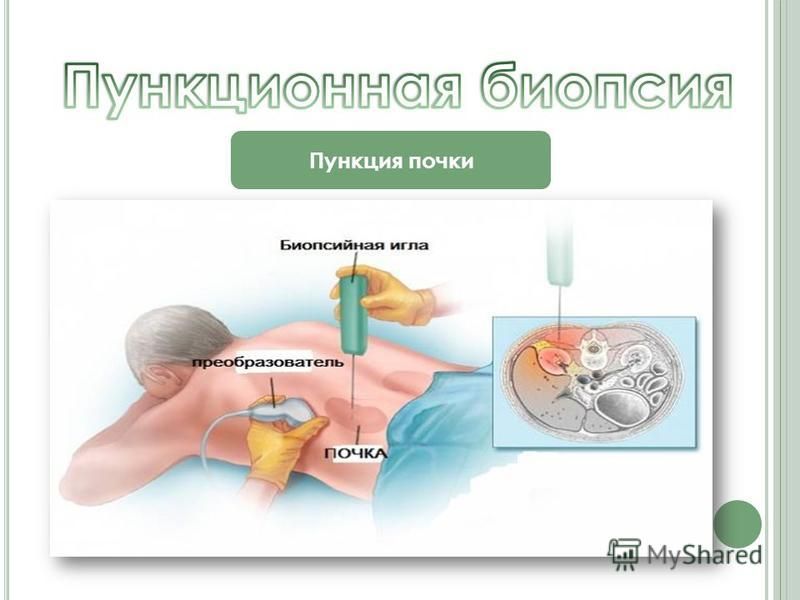 Пункция железы. Пункционная биопсия подготовка.