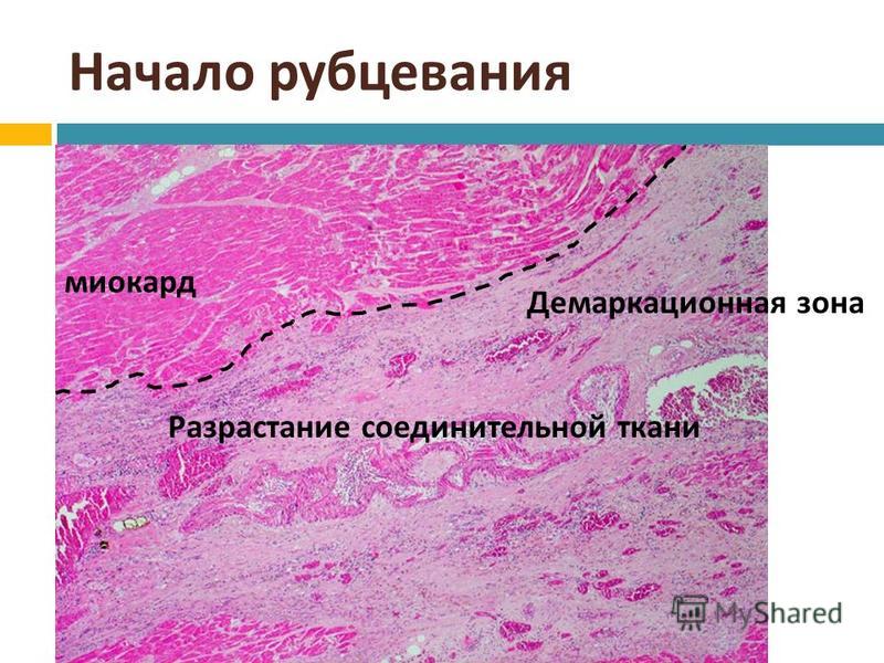 Разрастание ткани. Инфаркт миокарда патологическая анатомия демаркационная зона. Инфаркт миокарда гистология демаркационная линия. Трансмуральный инфаркт миокарда гистология. Демаркационная зона инфраки.