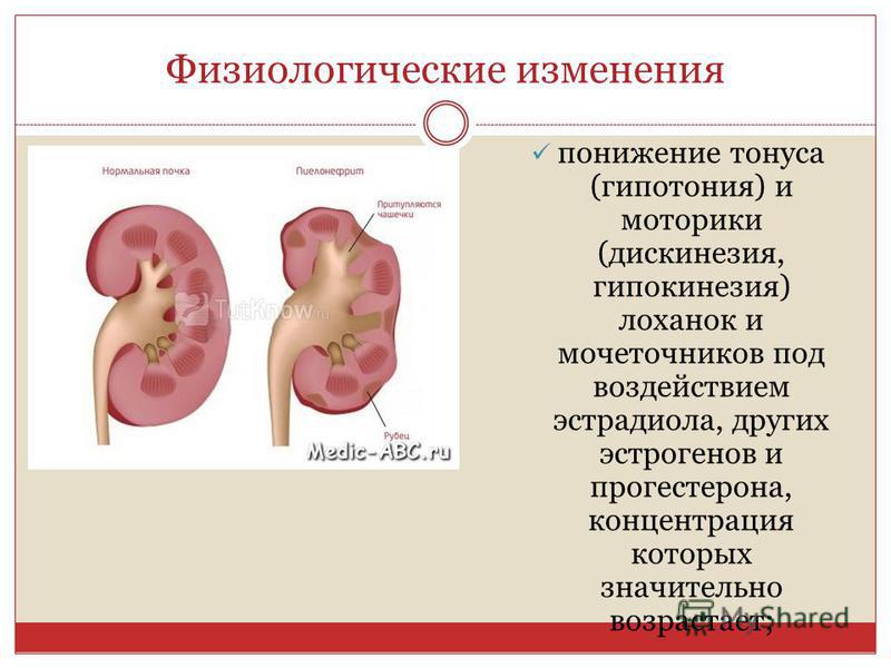 Уплотнение стенок лоханки почки у ребенка