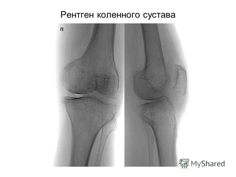 Рентген колена фото в норме