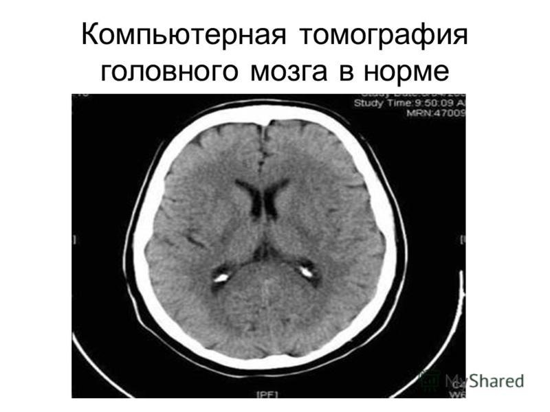 Кт головы стоя. Магнитно резонансные томограммы головного мозга. Компьютерная томография головного мозга норма. Кт головного мозга норма. Мрт головного мозга Сагиттальный срез.