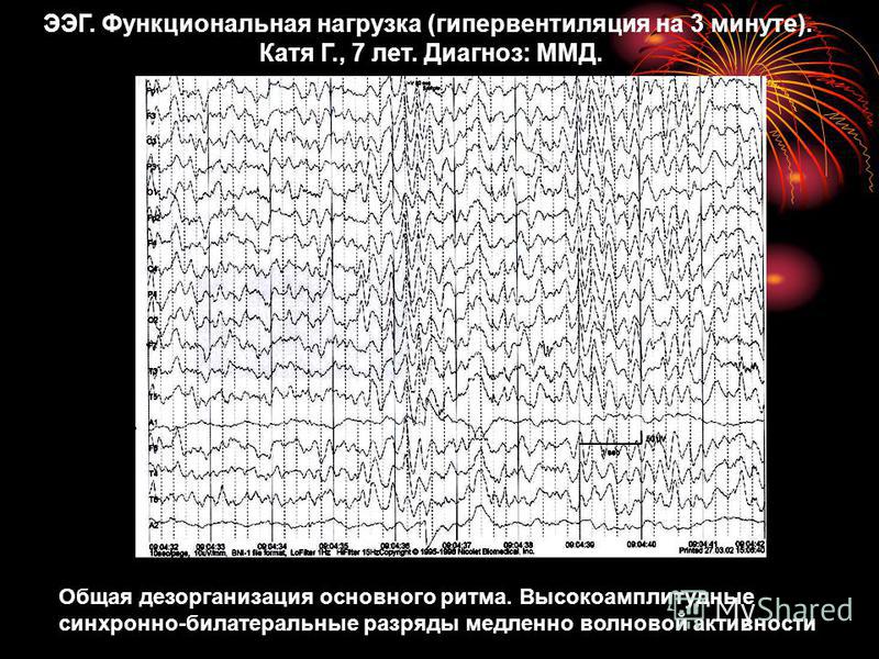 ЭЭГ (электроэнцефалограмма) головного мозга. Электроэнцефалограмма головного мозга описание. ЭЭГ здорового человека. Изменения ЭЭГ.