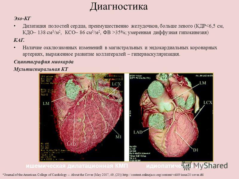 Изменения миокарда левого желудочка сердца. Гипокинезия миокарда. Гипокинезия миокарда левого желудочка. Диффузный гипокинез миокарда. Диффузная гипокинезия миокарда левого желудочка.