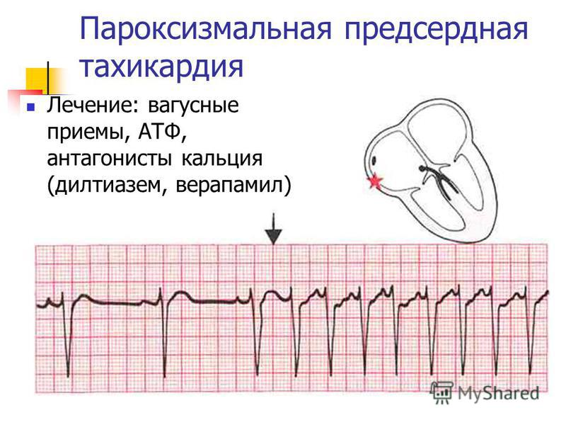 Тахикардия сердца что это такое. Предсердная пароксизмальная тахикардия на ЭКГ. Предсердная тахикардия на ЭКГ. Предсердная пароксизмальная тахикардия клиника. Пароксизмальная предсердная тахикардия лечение.