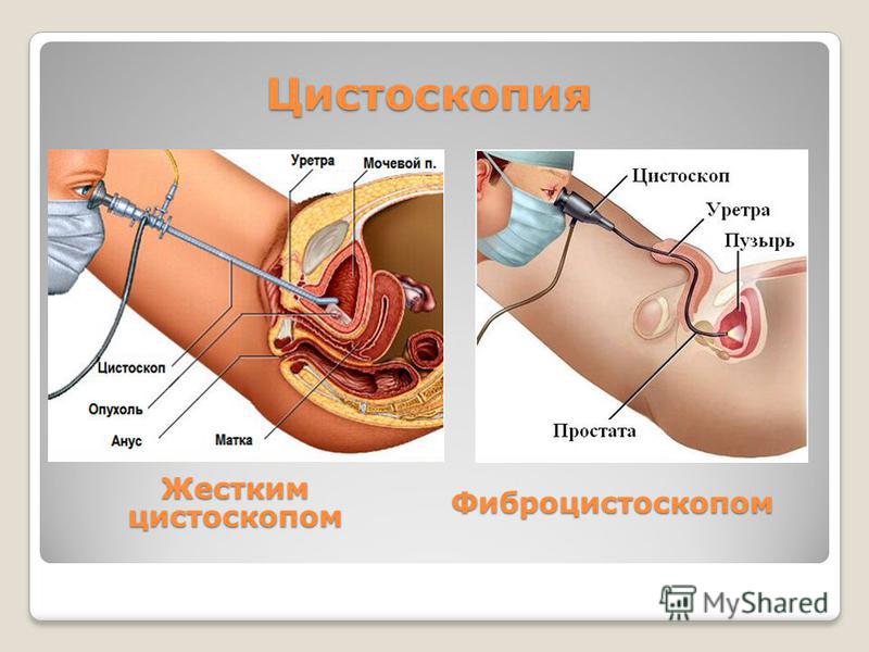 Заниматься Сексом С Полным Мочевым Пузырем