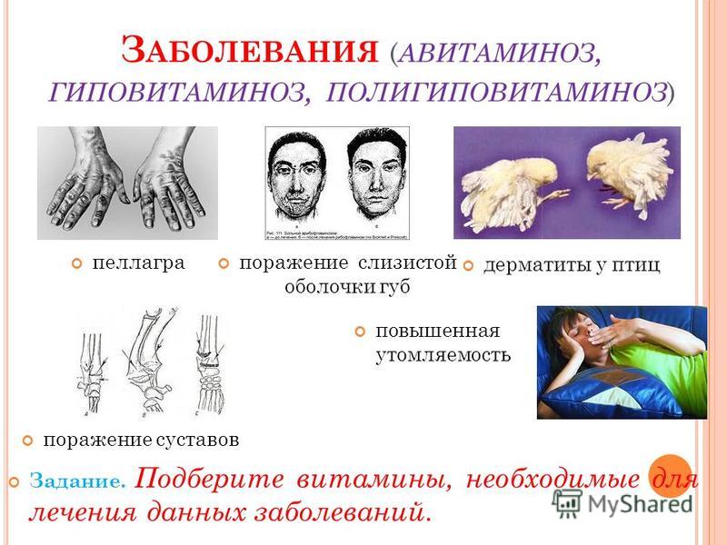 Авитаминоз это. Заболевания при авитаминозе. Авитаминозы названия болезней. Авитаминоз и гиповитаминоз. Витамин е авитаминоз и гиповитаминоз.