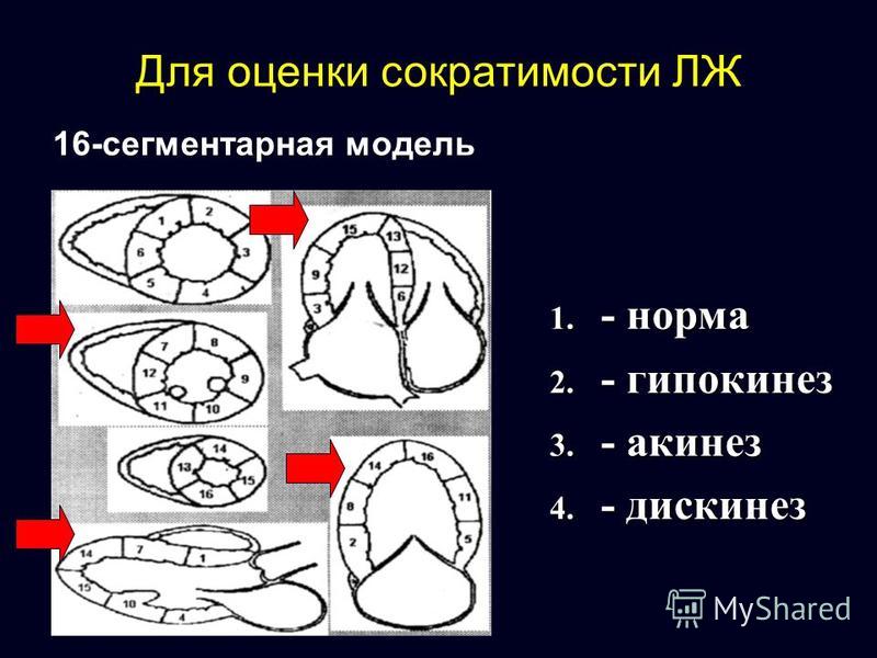 Локальная сократимость лж