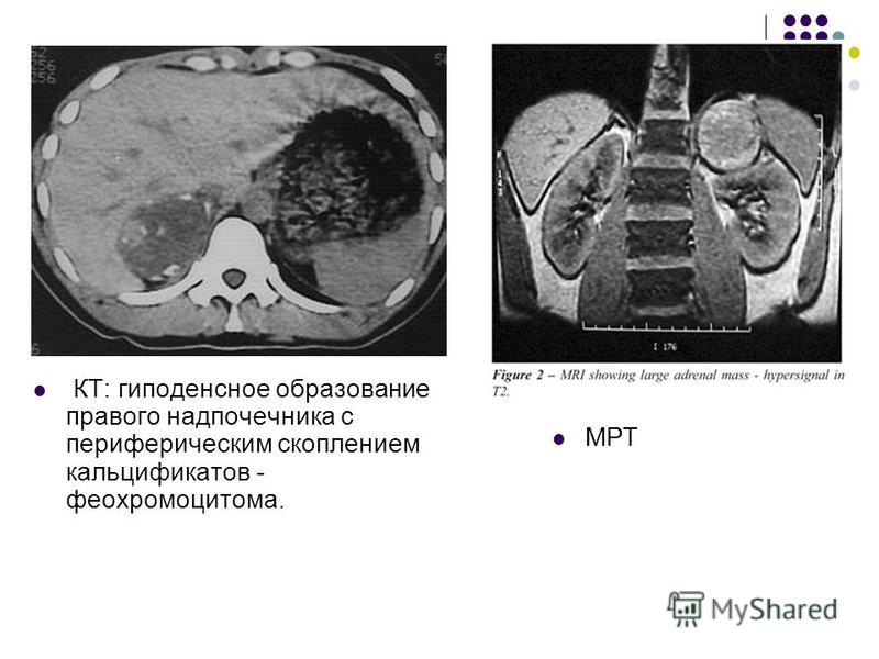 Гиподенсное образование в почке