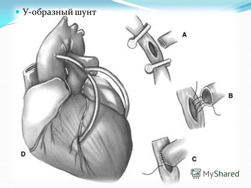 Шунтирование сердце простыми словами операция что такое. Аортокоронарное шунтирование техника операции. Аортокоронарное шунтирование (АКШ). Минимально инвазивное коронарное шунтирование. Операция на сердце шунтирование.