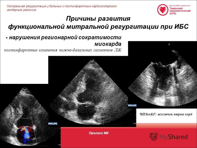 Регургитация 1 степени что это. Митральная подстворочная регургитация. Функциональная митральная регургитация. Приклапанная митральная регургитация. Функциональная регургитация митрального клапана.