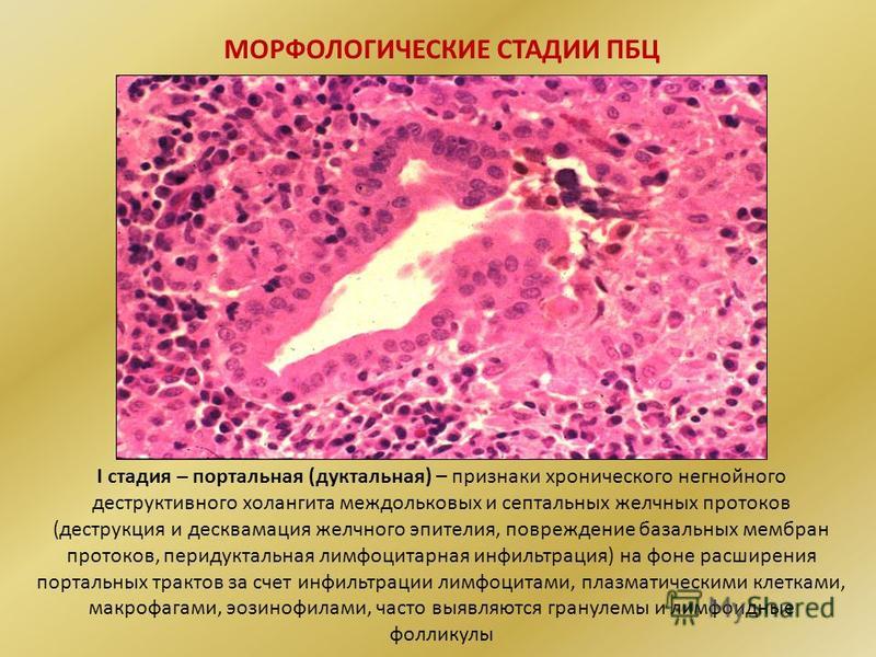 Билиарный цирроз это. Первичный билиарный цирроз печени гистология. Первичный склерозирующий холангит микропрепарат.