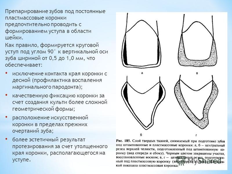 Коронка на передний зуб схема