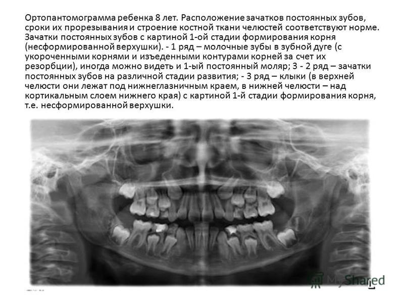 Рентгенологическая картина зубов и их зачатков на различных этапах формирования