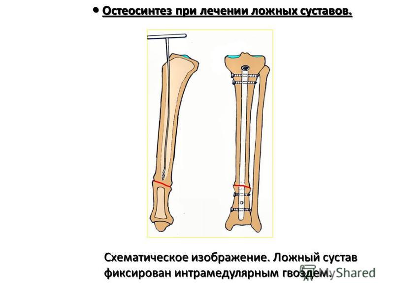 Остеосинтез локтевого отростка по веберу