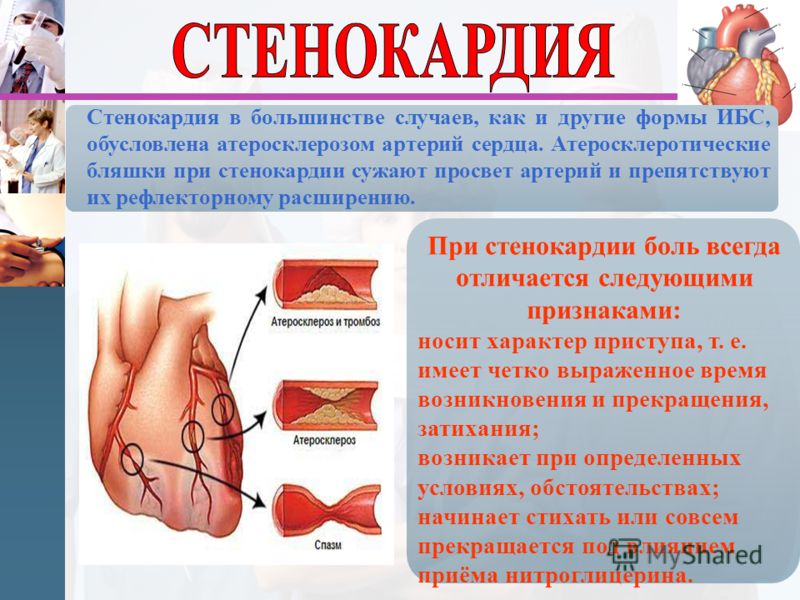 Симптомы болезни сердца. Профилактика стенокардии. Стенокардия памятка.