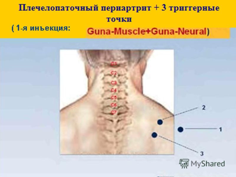 Лечение плечелопаточного периартрита видео. Плечелопаточный периартрит триггерные точки. Точки при плечелопаточном периартрите. Точки массажа при плечелопаточном периартрите. Боль в шее при плечелопаточном периартрите.