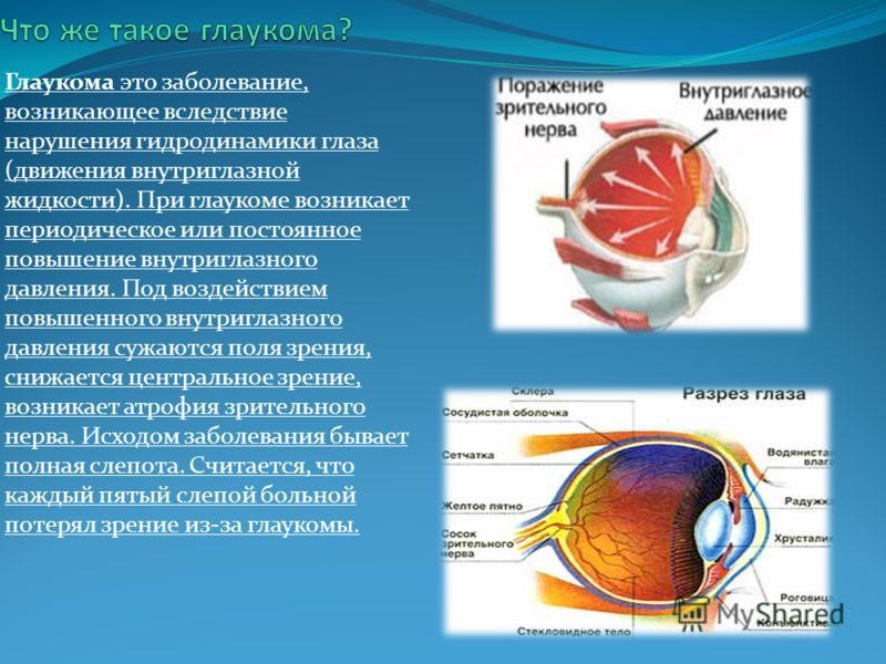 Можно вернуть зрение при глаукоме. Повышение внутриглазного давления (глаукома).. Глаукома внутриглазное давление при глаукоме. При глаукоме глазное яблоко при надавливании:.