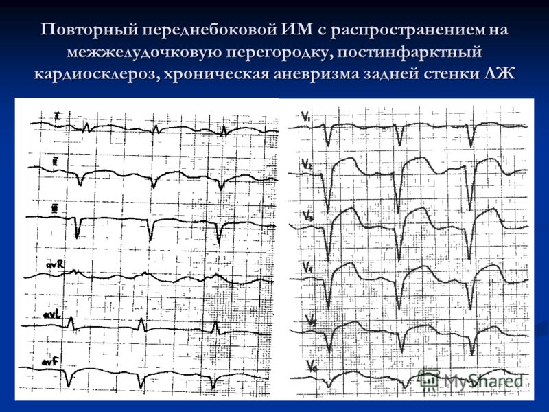 Инфаркт миокарда межжелудочковой перегородки на ЭКГ. Инфаркт миокарда переднебоковой стенки лж. Инфаркт перегородки передней стенки. Диффузные изменения экг что это значит