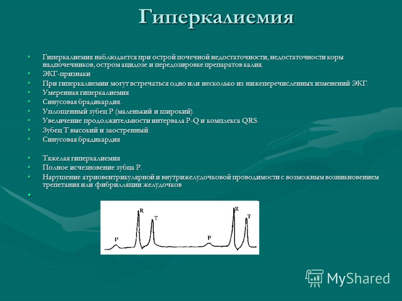 Гиперкалиемия на экг