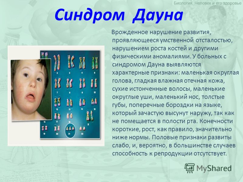 Синдром презентация. Болезнь Дауна описание. Синдром Дауна презентация. Болезнь Дауна кратко. Болезнь Дауна презентация.